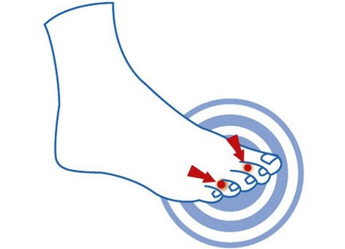 epitact Zehendruckschutzpolster HAUT